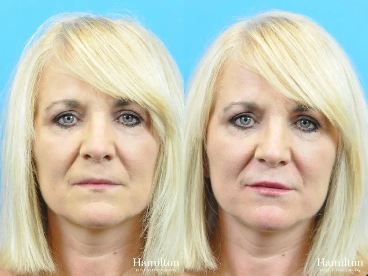 Fillers: Patient 10 - Before and After 1