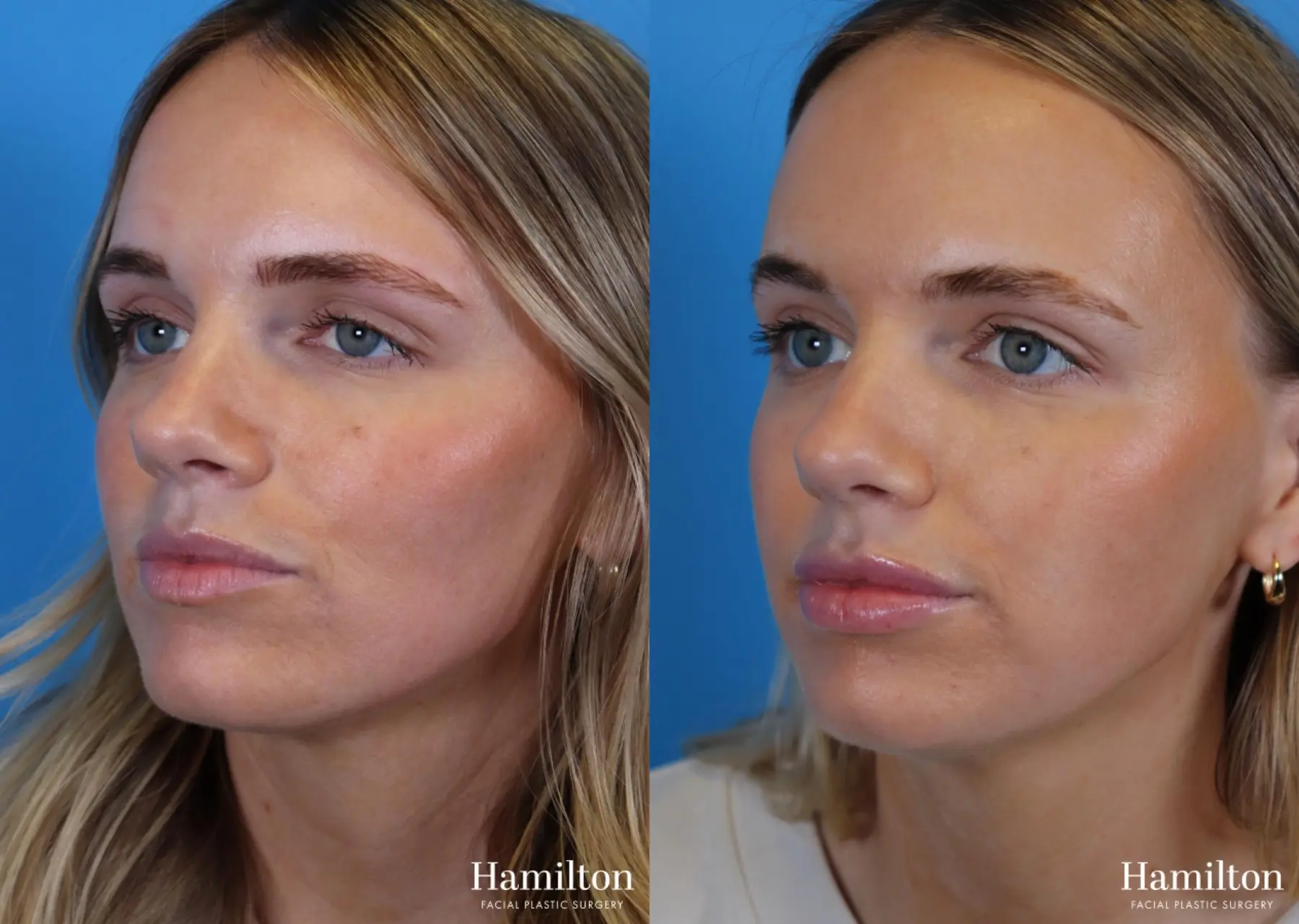 Fillers: Patient 3 - Before and After 2