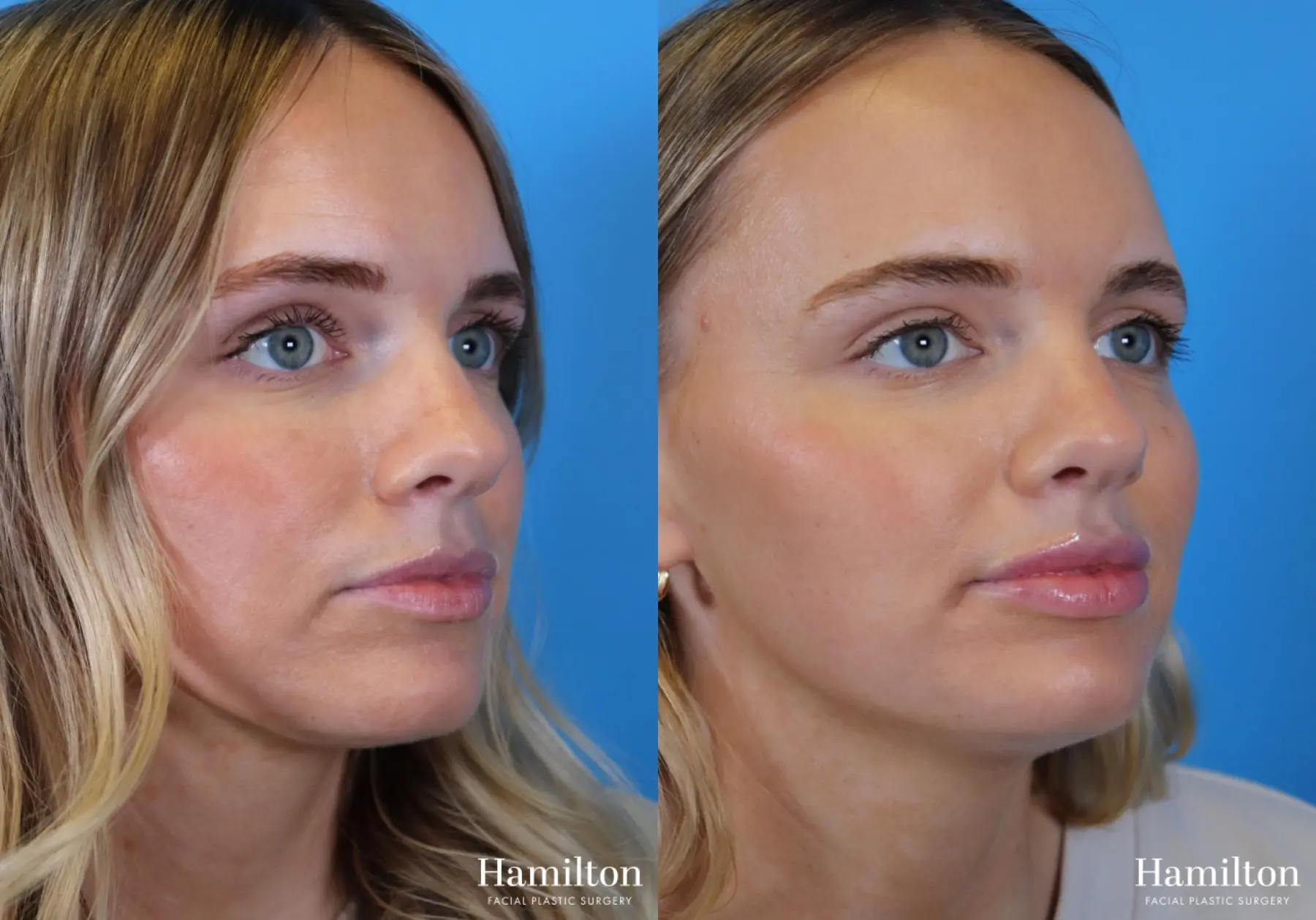 Fillers: Patient 3 - Before and After  