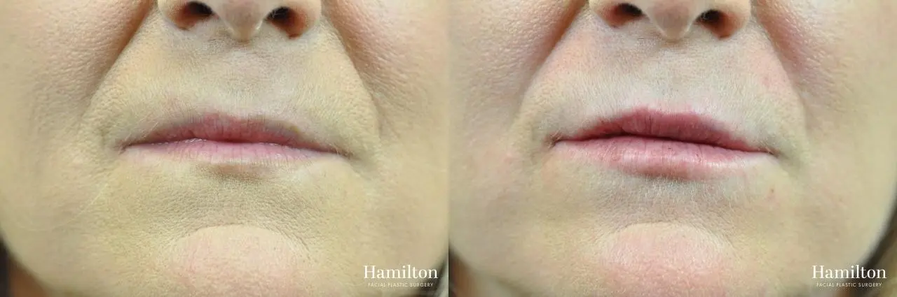 Fillers: Patient 10 - Before and After 2