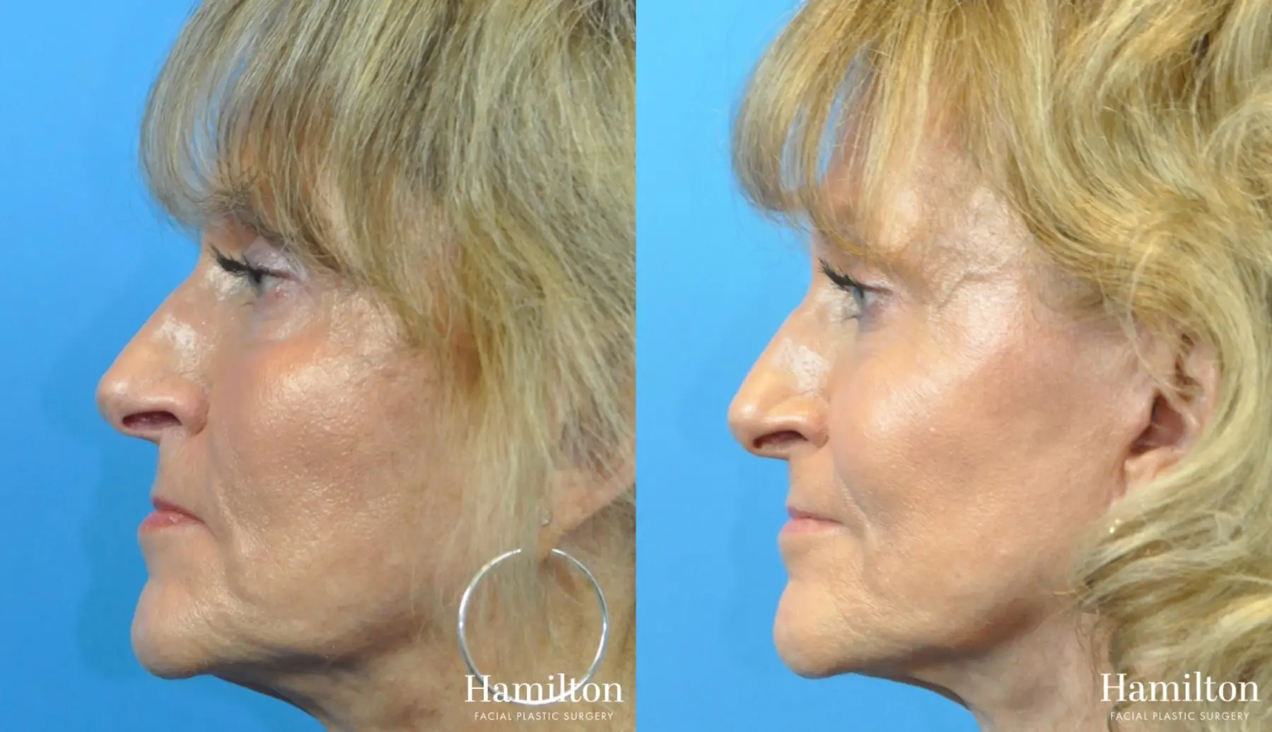 Fillers: Patient 13 - Before and After 1