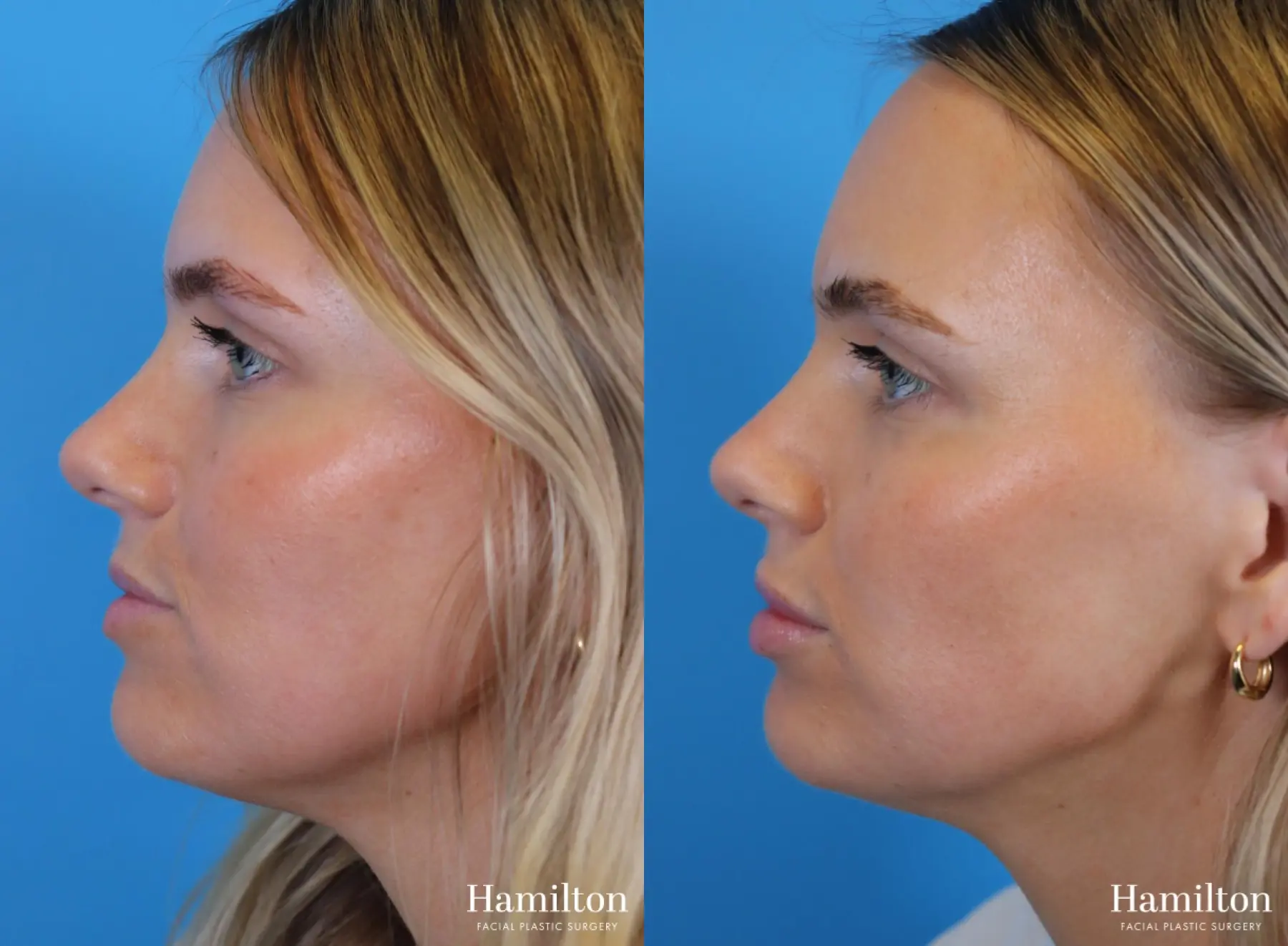 Fillers: Patient 3 - Before and After 4