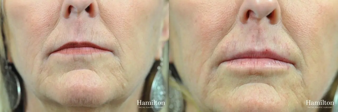 Fillers: Patient 12 - Before and After 1