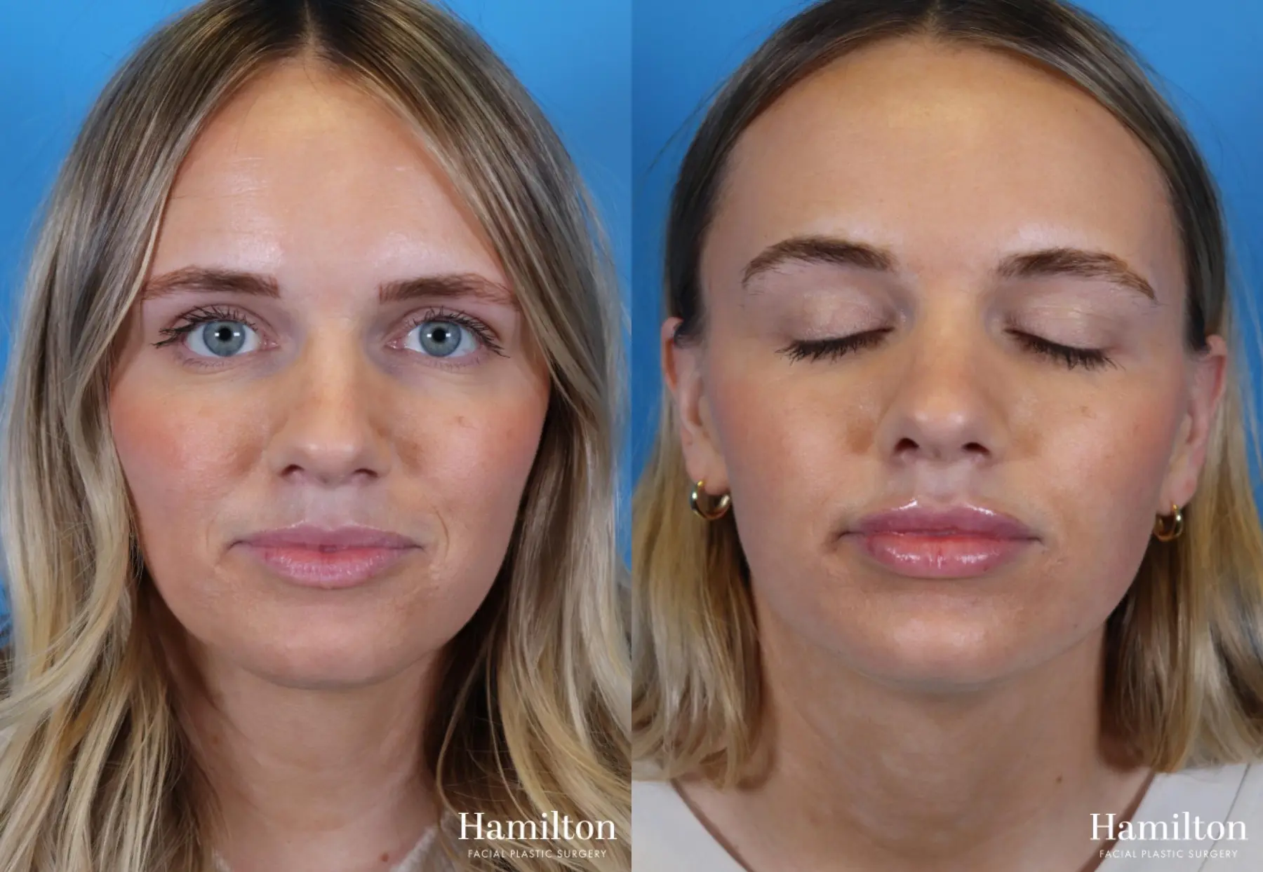 Fillers: Patient 3 - Before and After 3