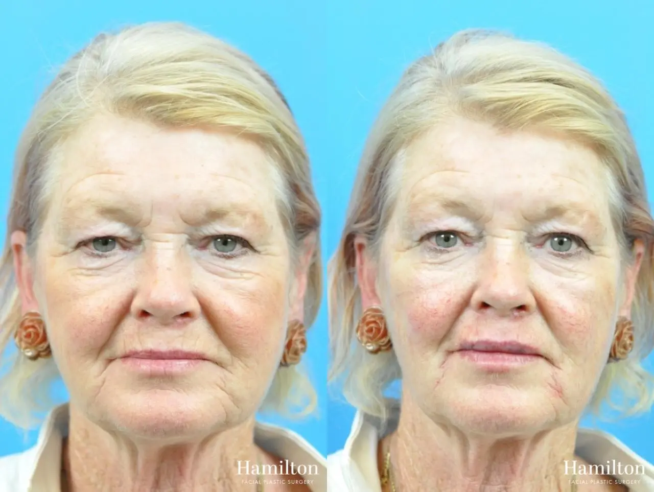 Fillers: Patient 11 - Before and After 1