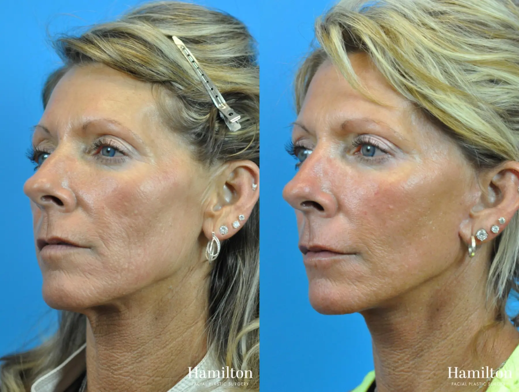 Fractional Resurfacing: Patient 2 - Before and After 1