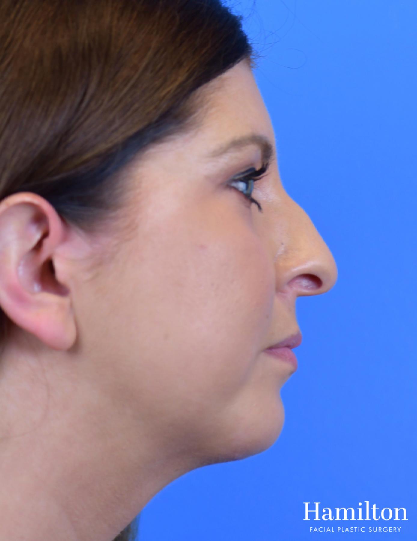 Chin Augmentation: Patient 10 - After 5