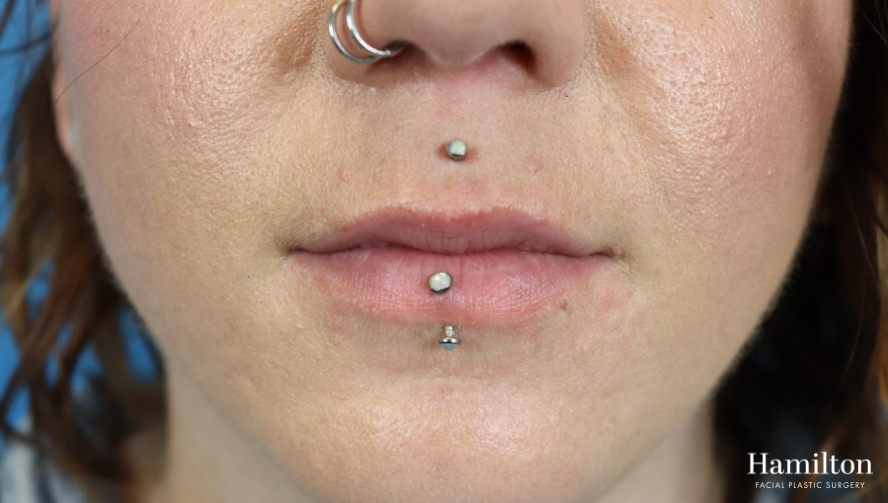 Fillers: Patient 7 - Before 