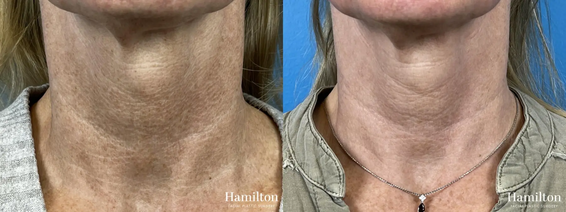 HALO Laser: Patient 2 - Before and After 6