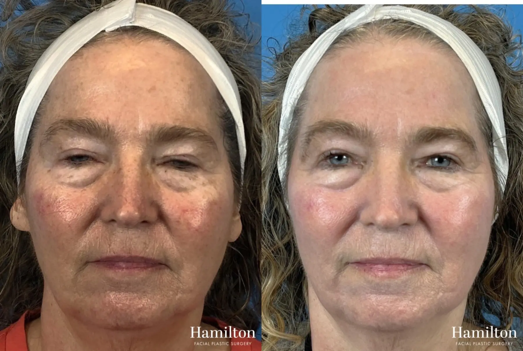 HALO Laser: Patient 4 - Before and After 2
