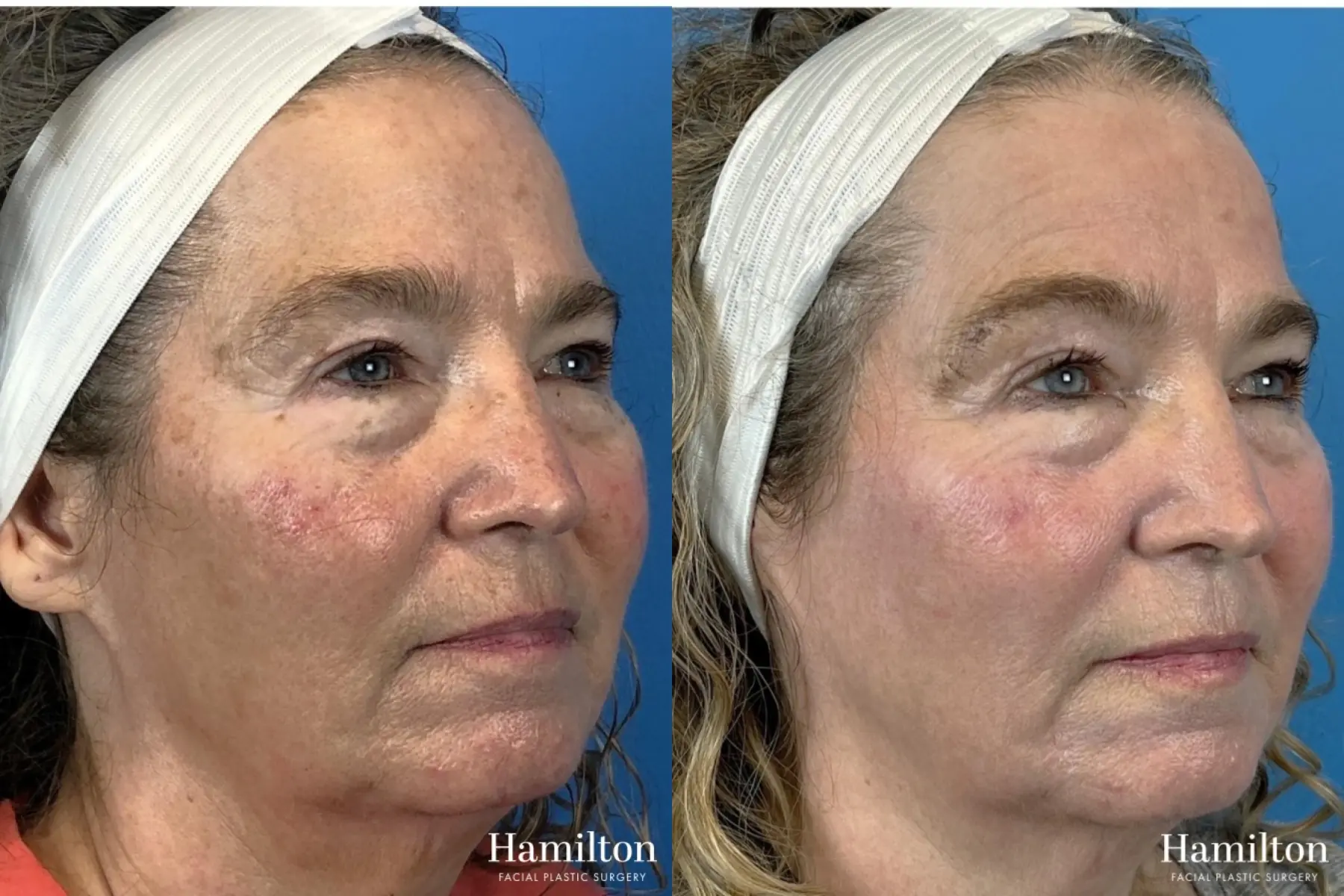 HALO Laser: Patient 4 - Before and After  