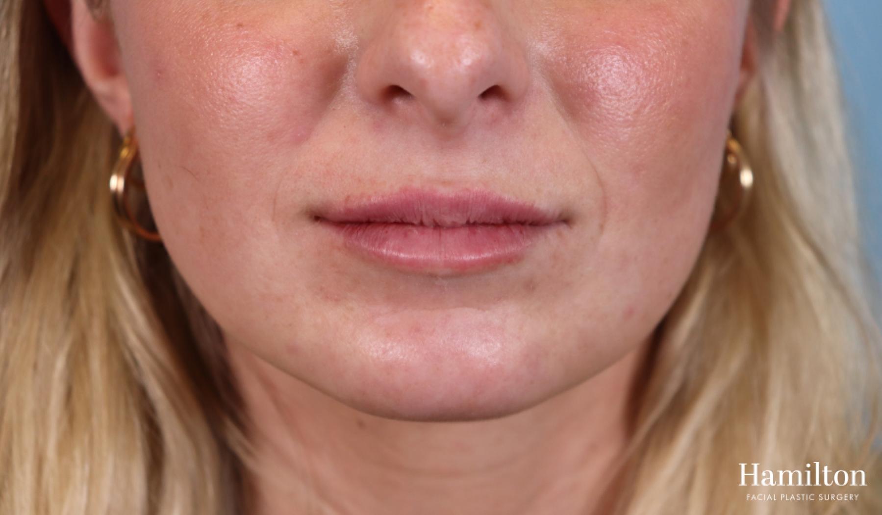 Lip Enhancement: Patient 7 - After 2