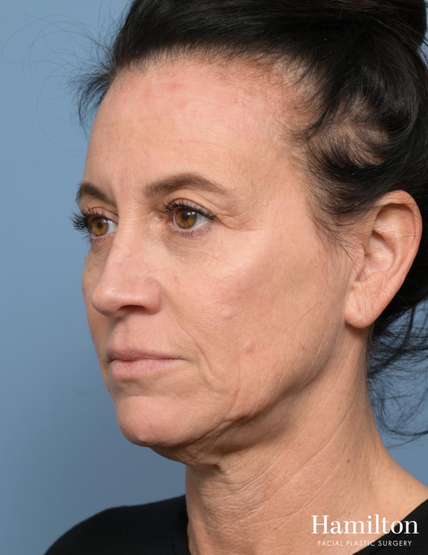 Facelift: Patient 29 - Before 1