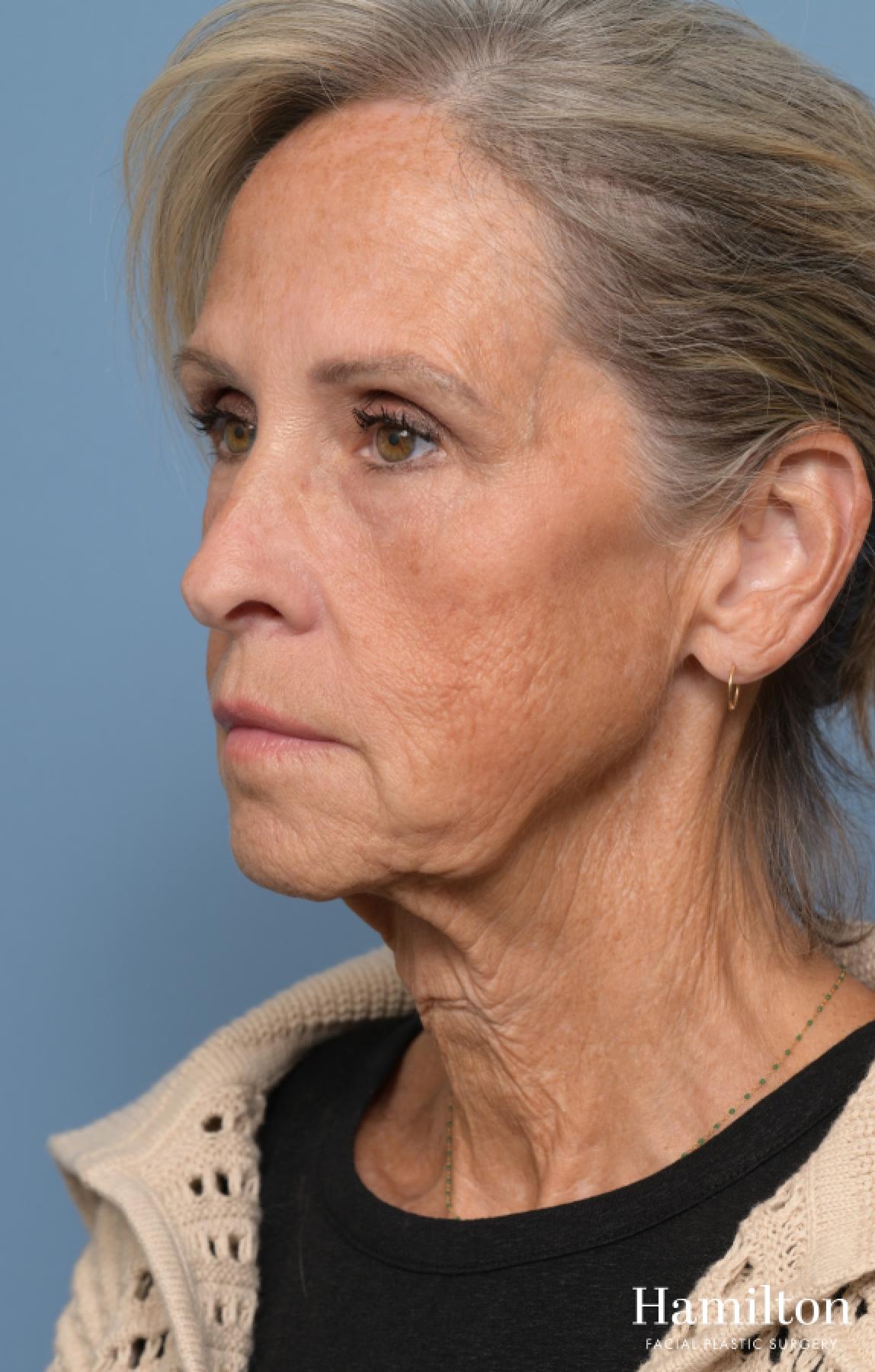 Fat Grafting: Patient 1 - Before 4