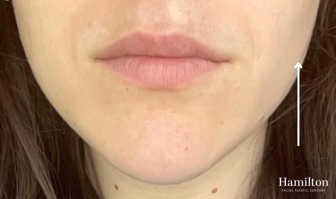 Neurotoxins/Botox: Patient 11 - After 1