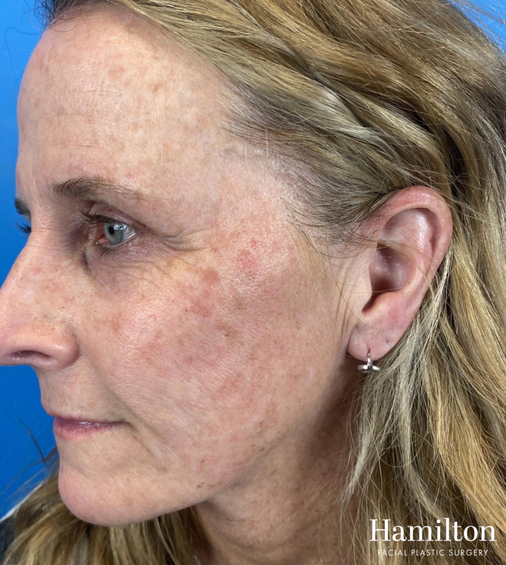 HALO Laser: Patient 3 - Before and After 3