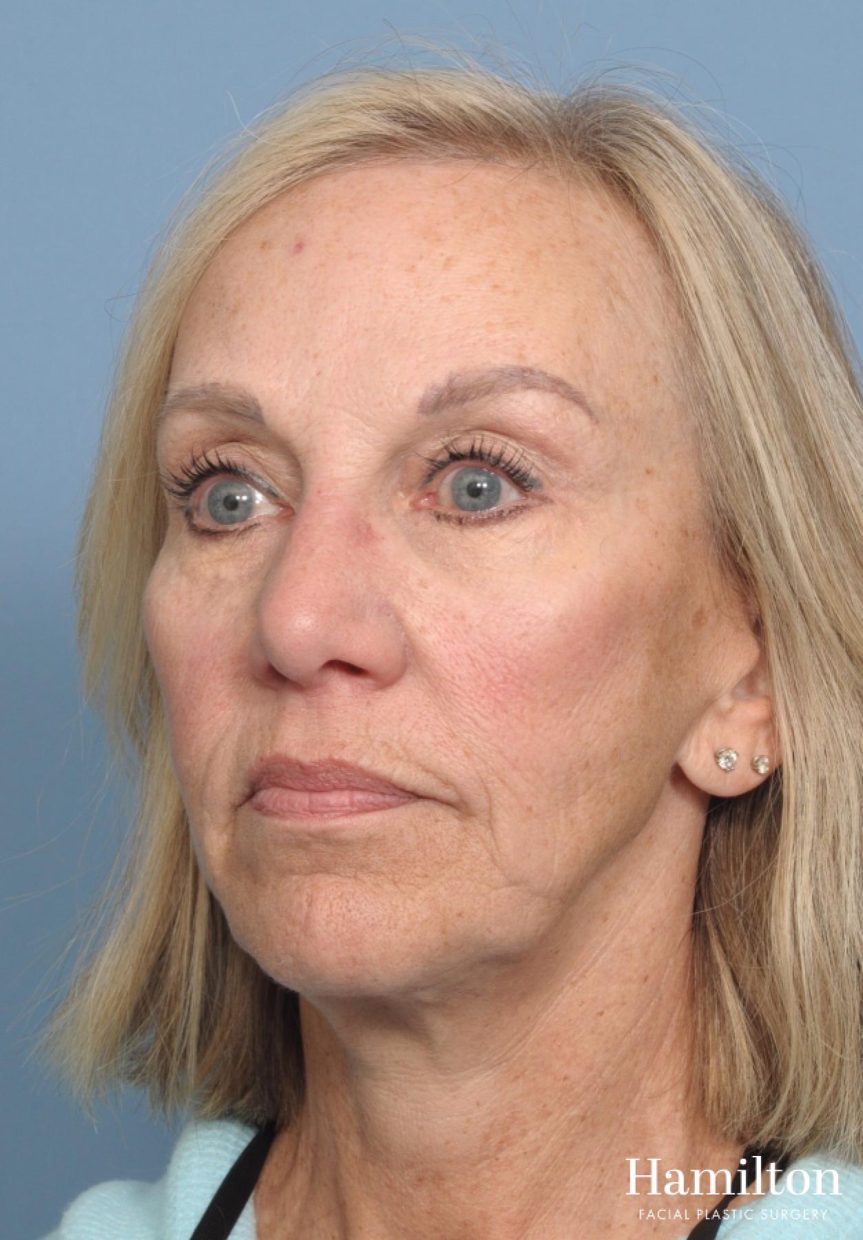 Mini Facelift: Patient 1 - Before and After 5