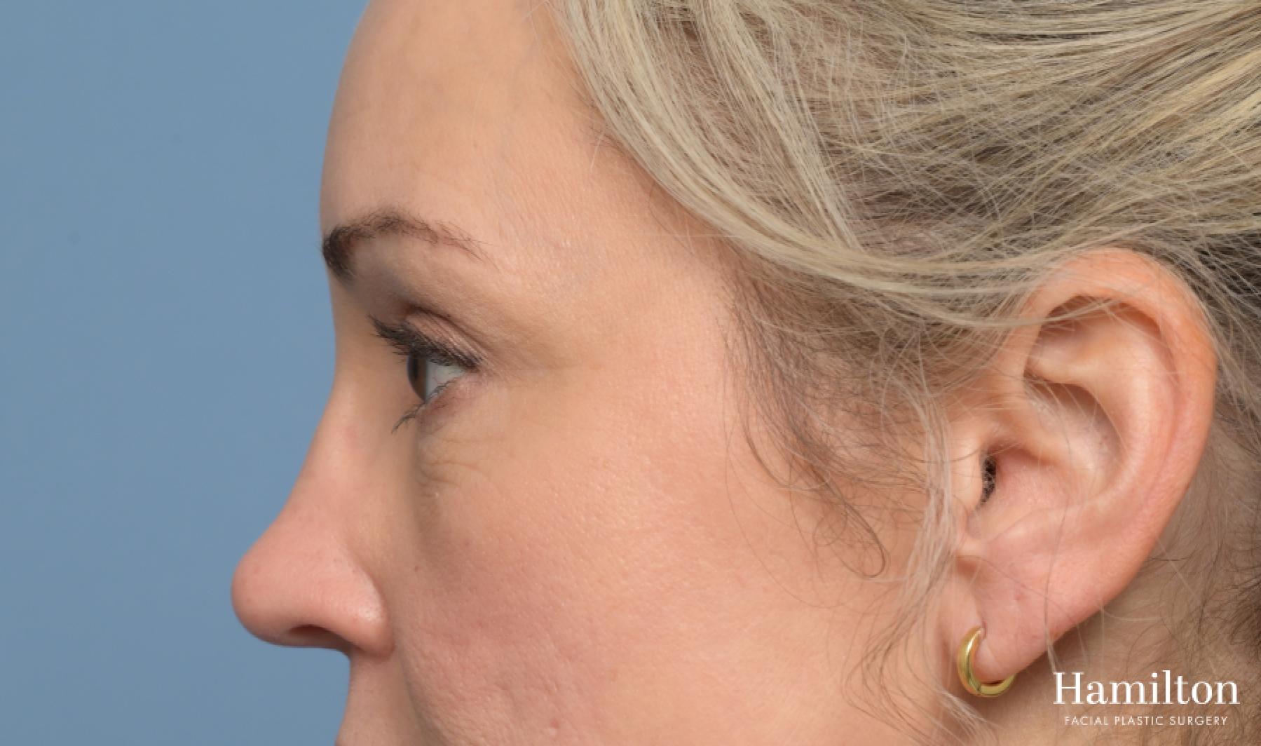 Blepharoplasty: Patient 5 - After 2