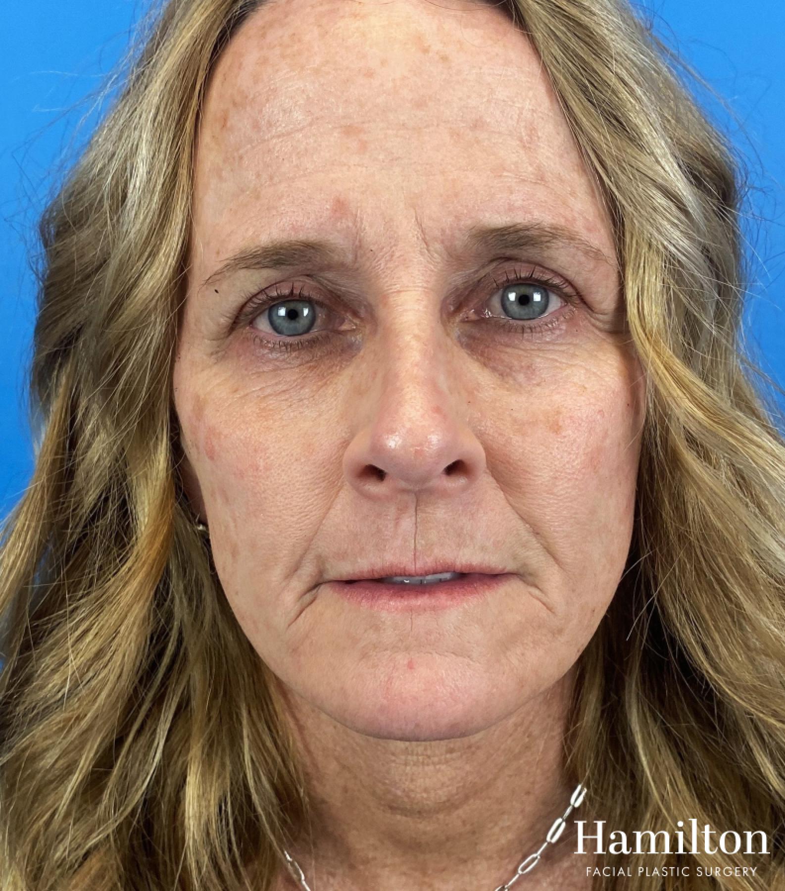 Broad Band Light (BBL): Patient 10 - Before 2