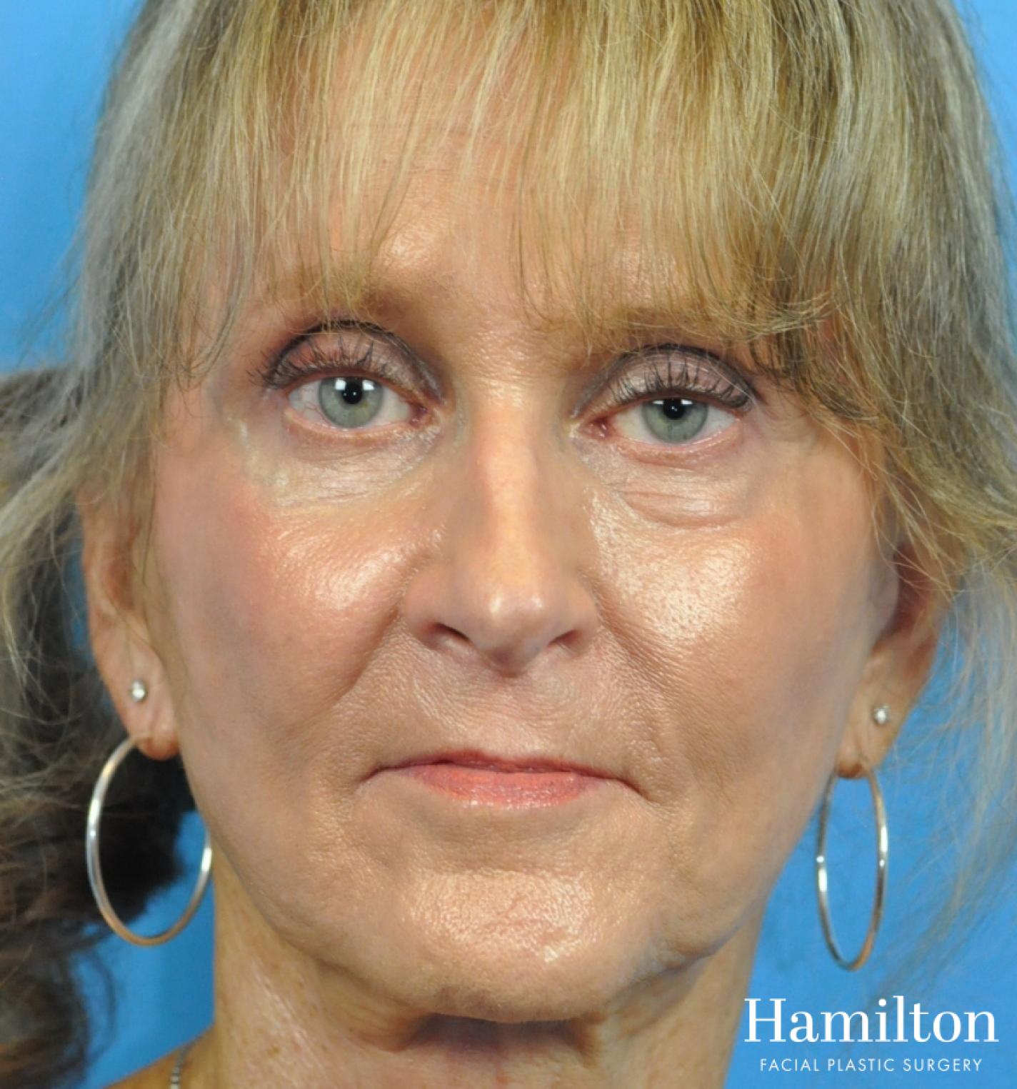 Fillers: Patient 13 - Before and After 3