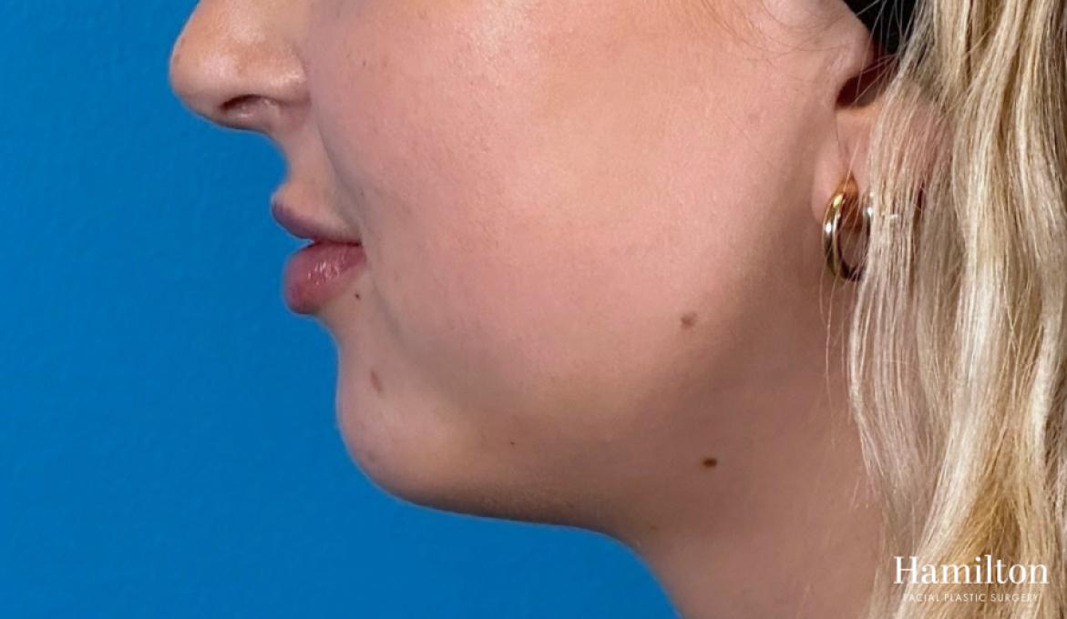 Lip Enhancement: Patient 3 - After 3