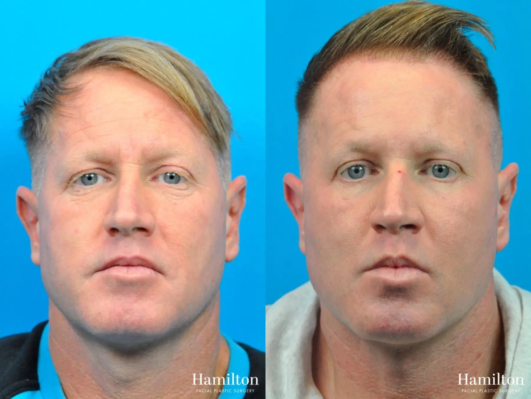 Laser - Fractional Resurfacing: Patient 1 - Before and After  