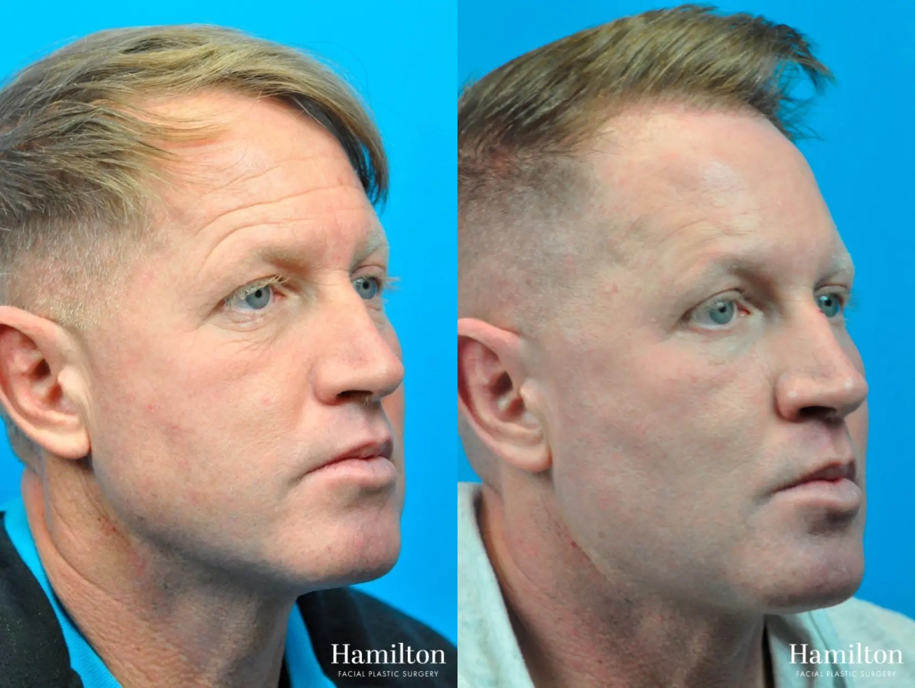 Laser - Fractional Resurfacing: Patient 1 - Before and After 2