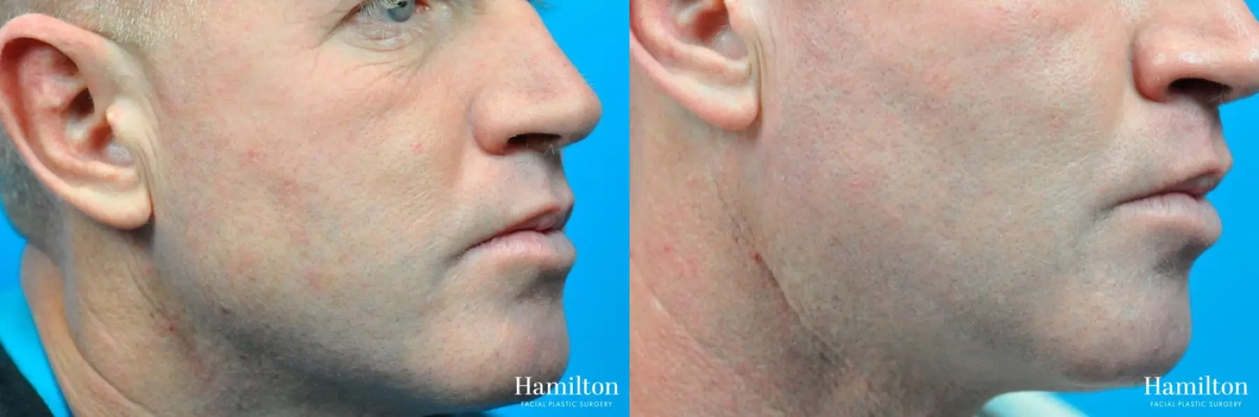 Laser - Fractional Resurfacing: Patient 1 - Before and After 3