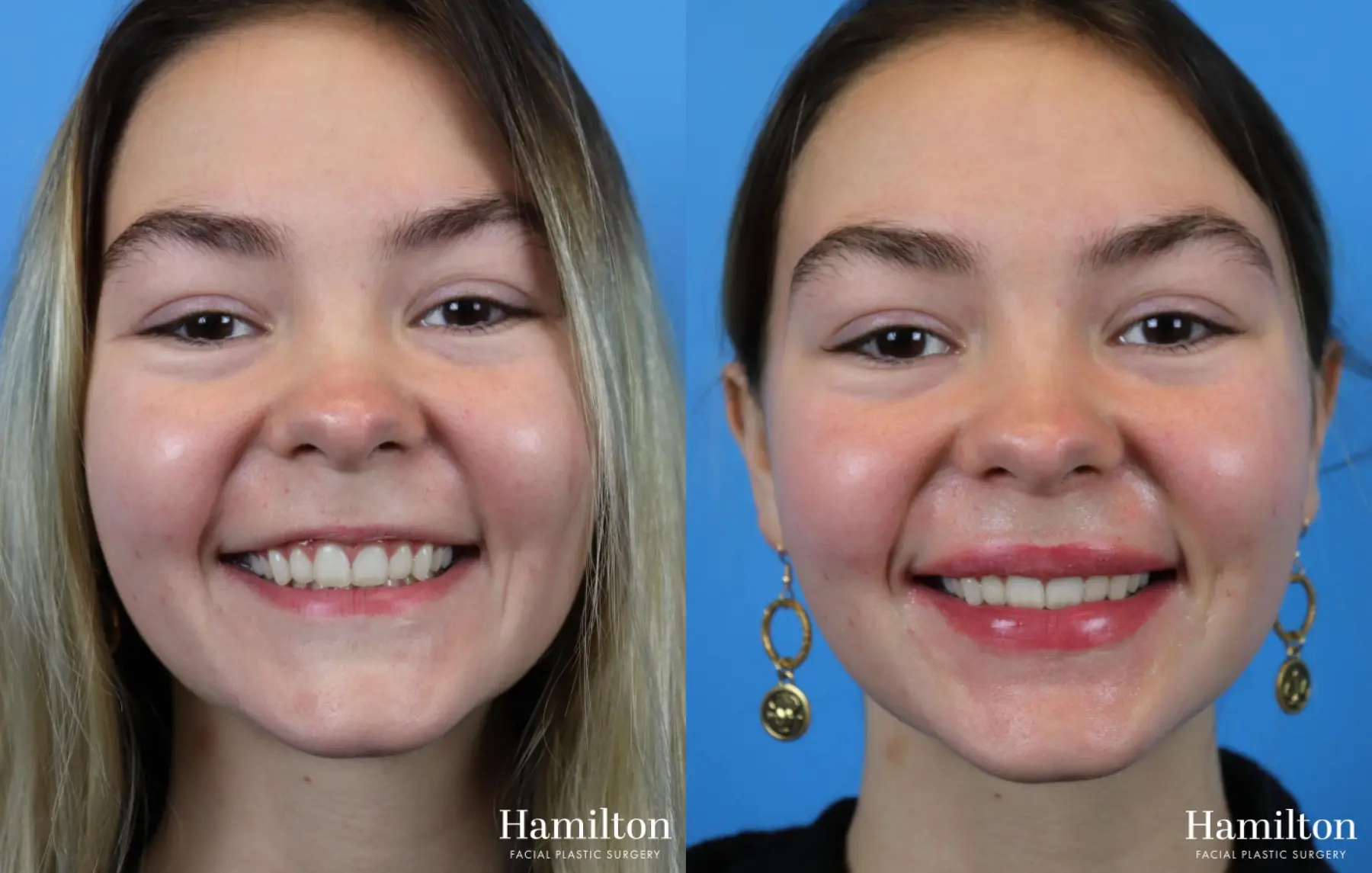 Lip Enhancement: Patient 2 - Before and After  