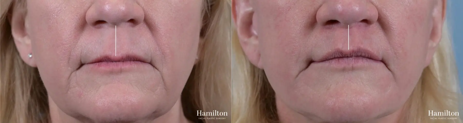 Lip Enhancement: Patient 8 - Before and After  