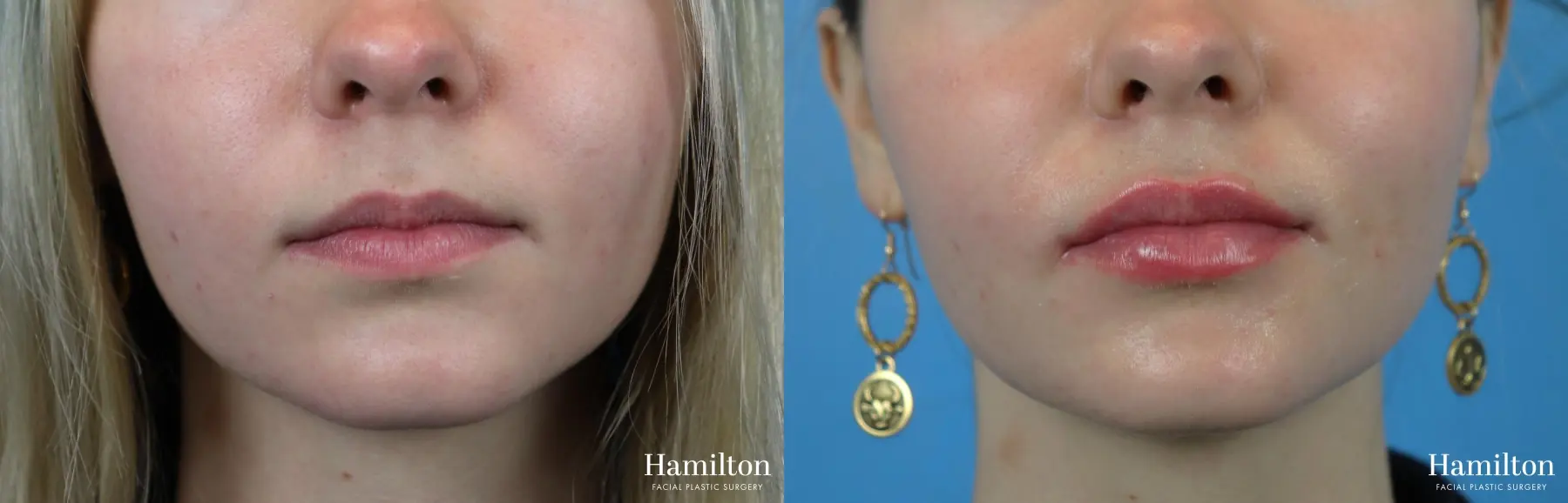 Lip Enhancement: Patient 2 - Before and After 2