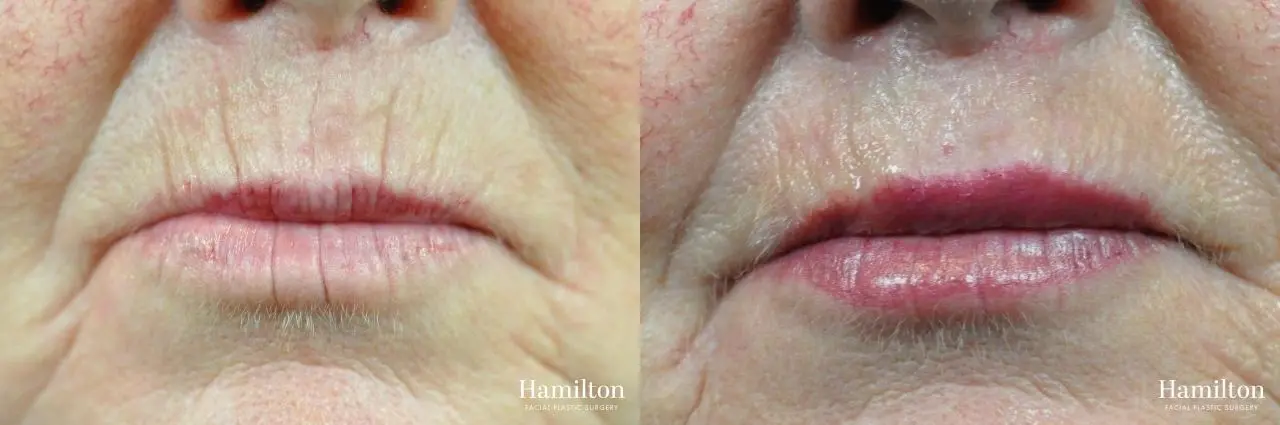 Lip Enhancement: Patient 13 - Before and After 2