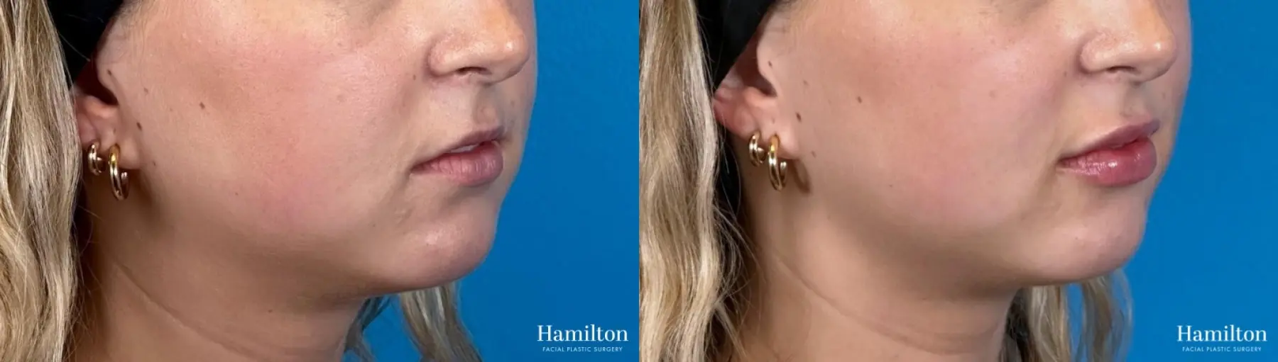 Lip Enhancement: Patient 3 - Before and After 2