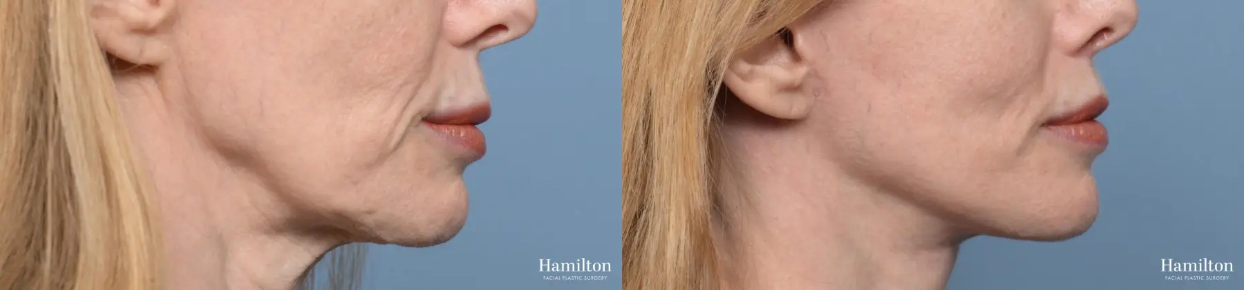 Lip Lift: Patient 1 - Before and After  