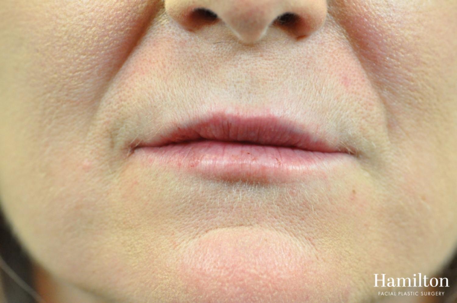 Lip Enhancement: Patient 9 - After 2