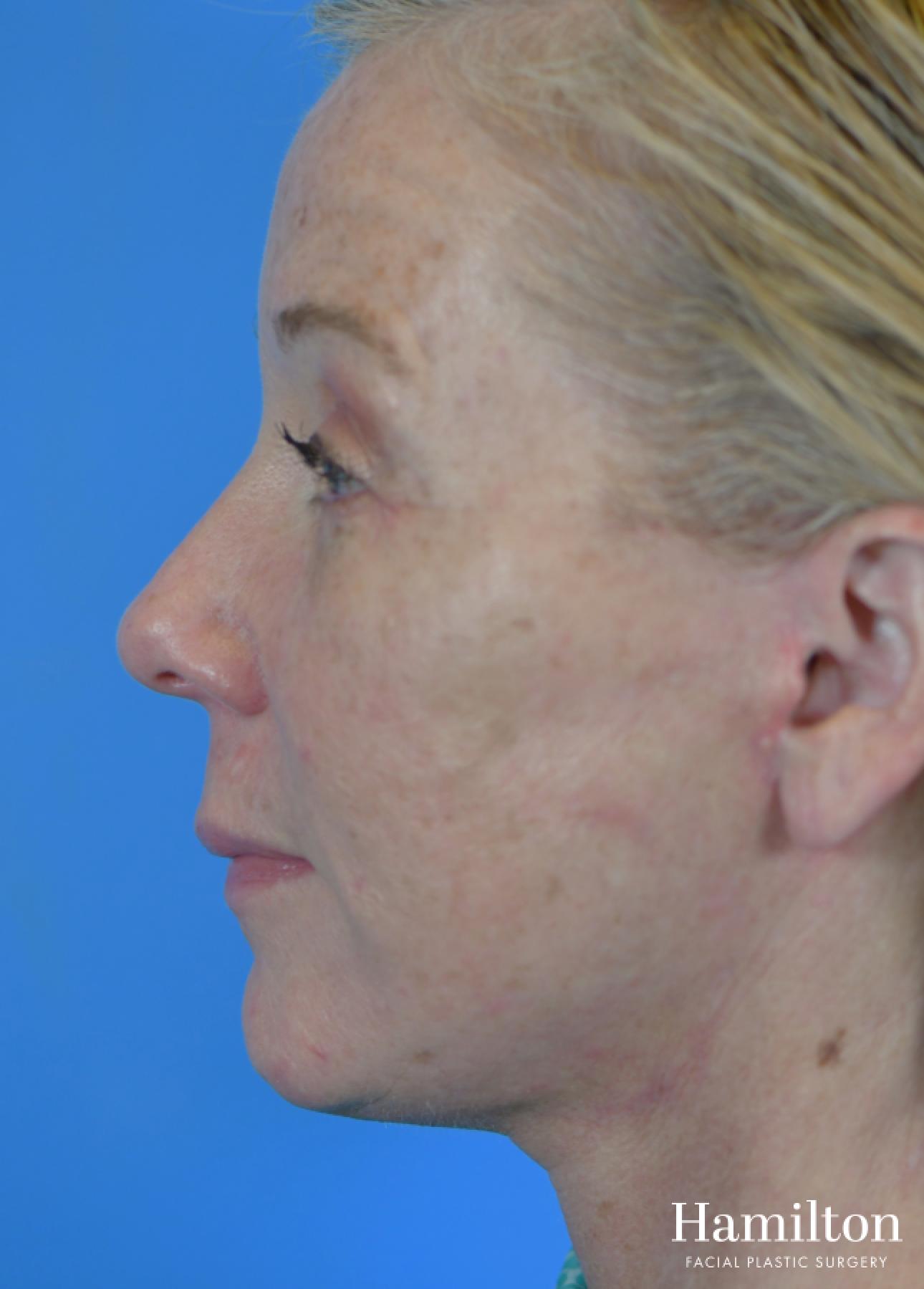 Facelift: Patient 37 - After 5