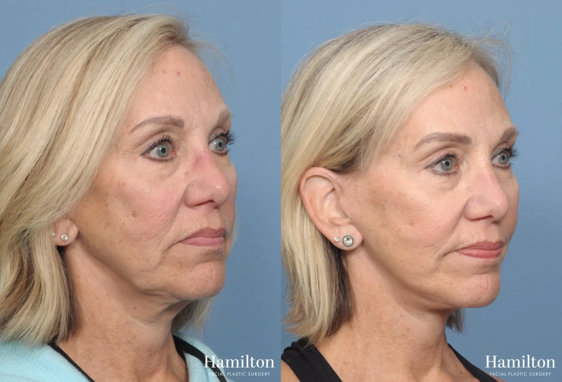 Mini Facelift: Patient 1 - Before and After 4