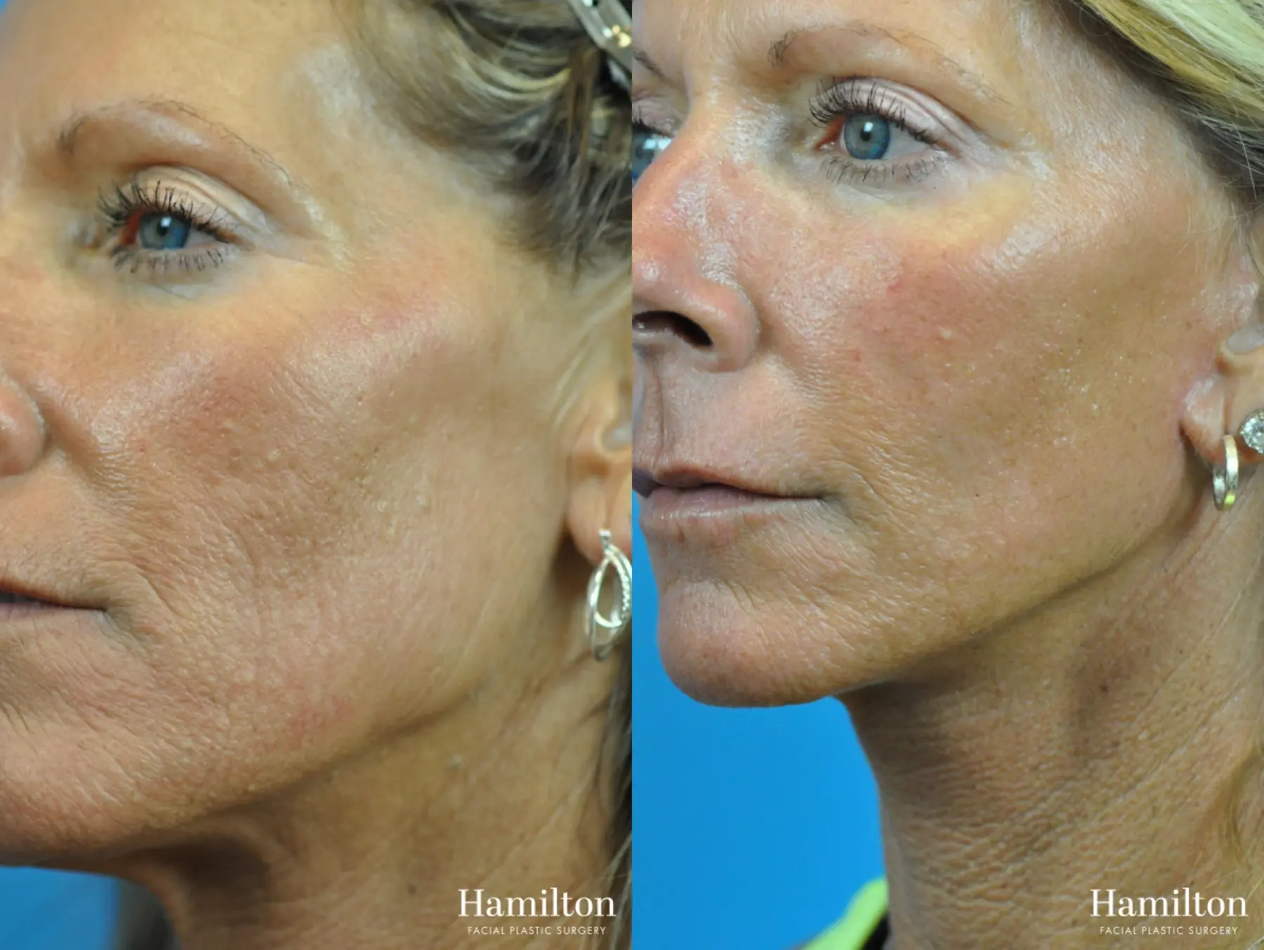 Mini Facelift: Patient 3 - Before and After 2
