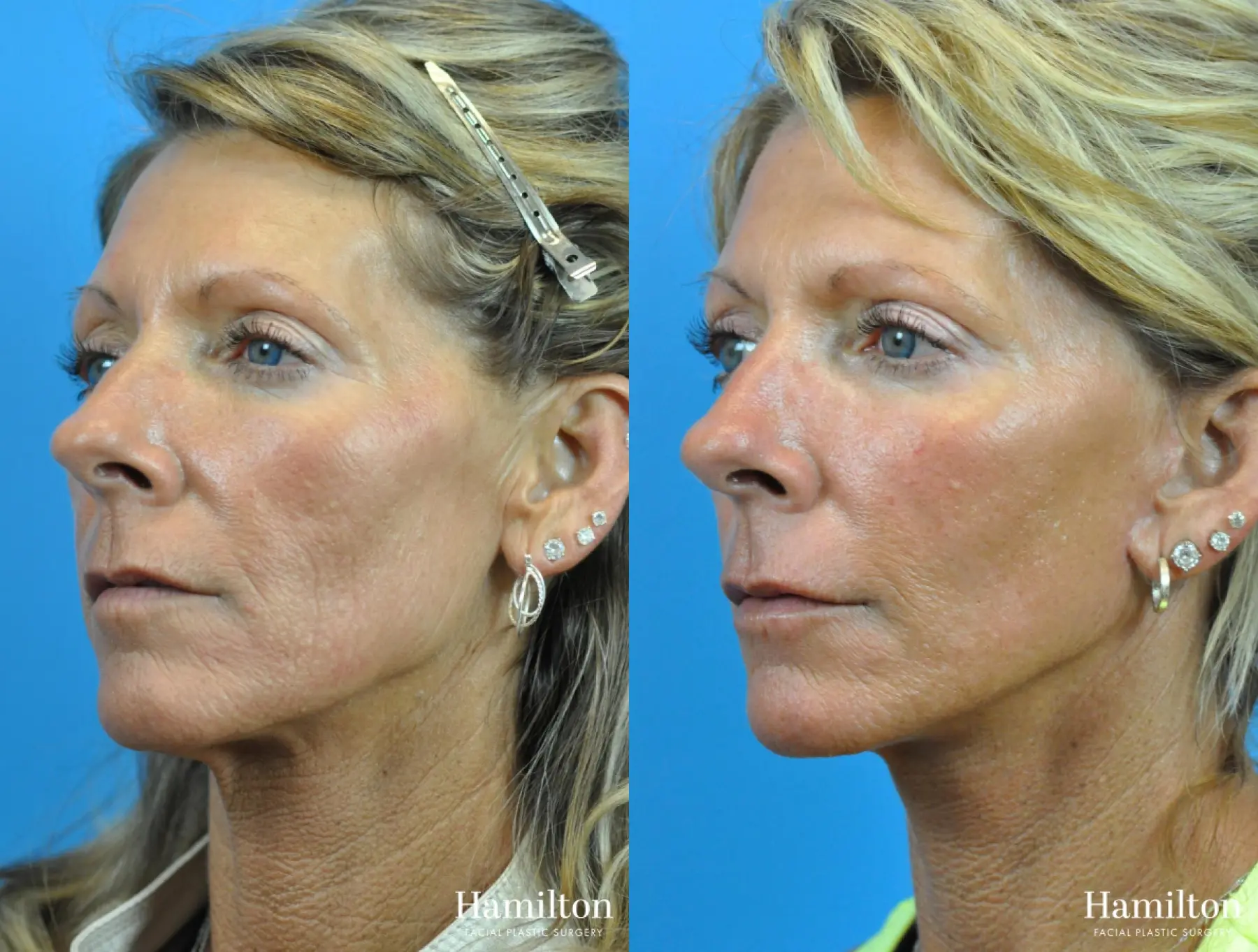 Mini Facelift: Patient 1 - Before and After 1