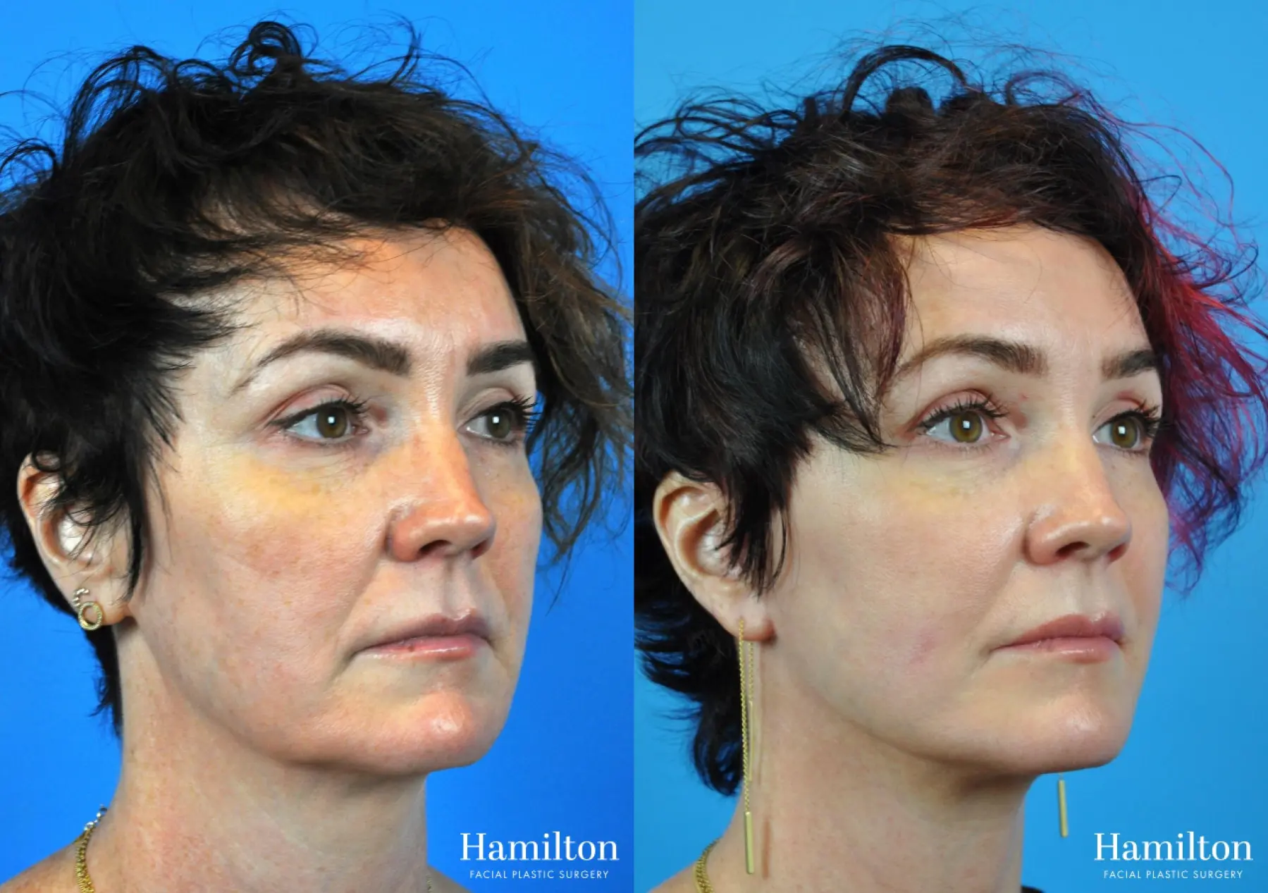 Mini Facelift: Patient 2 - Before and After 3