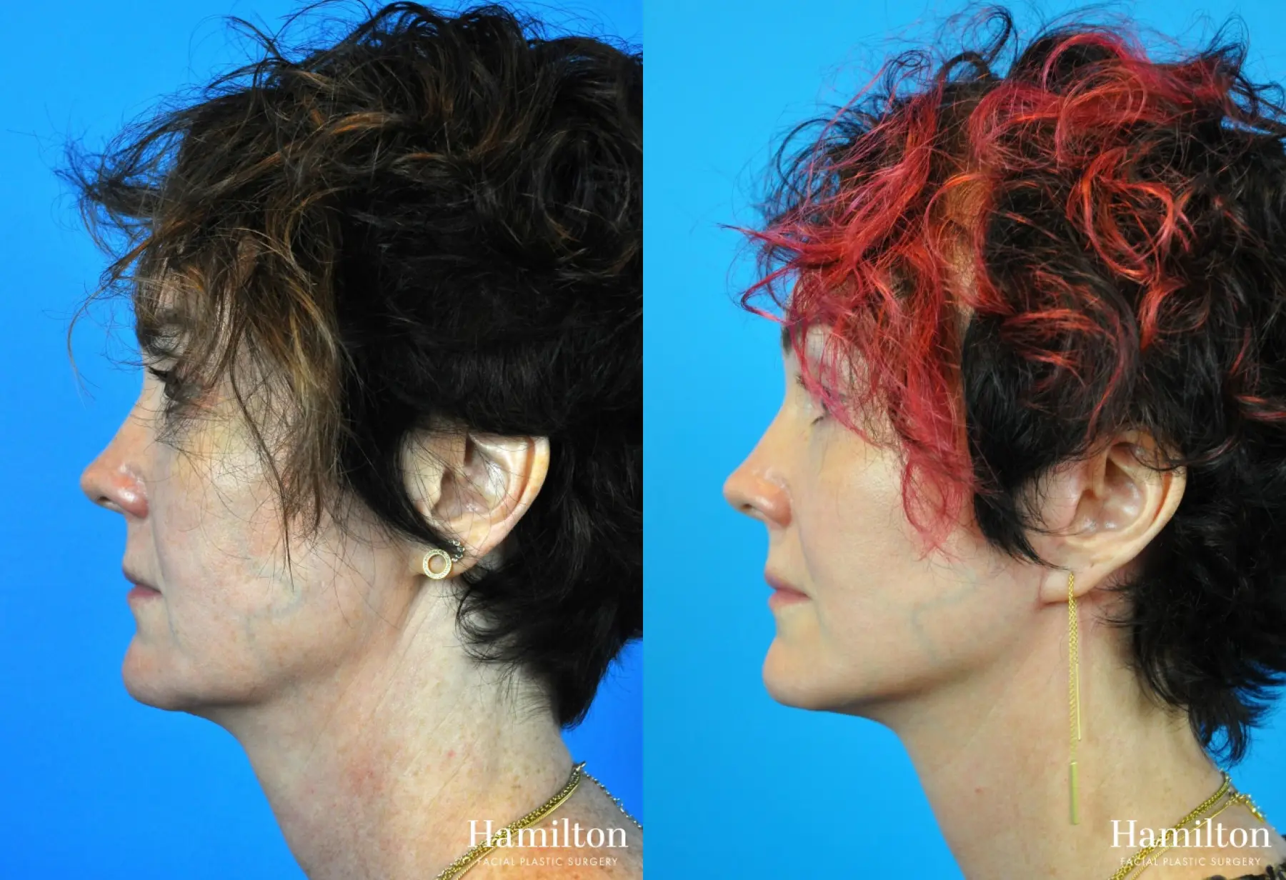 Mini Facelift: Patient 2 - Before and After  