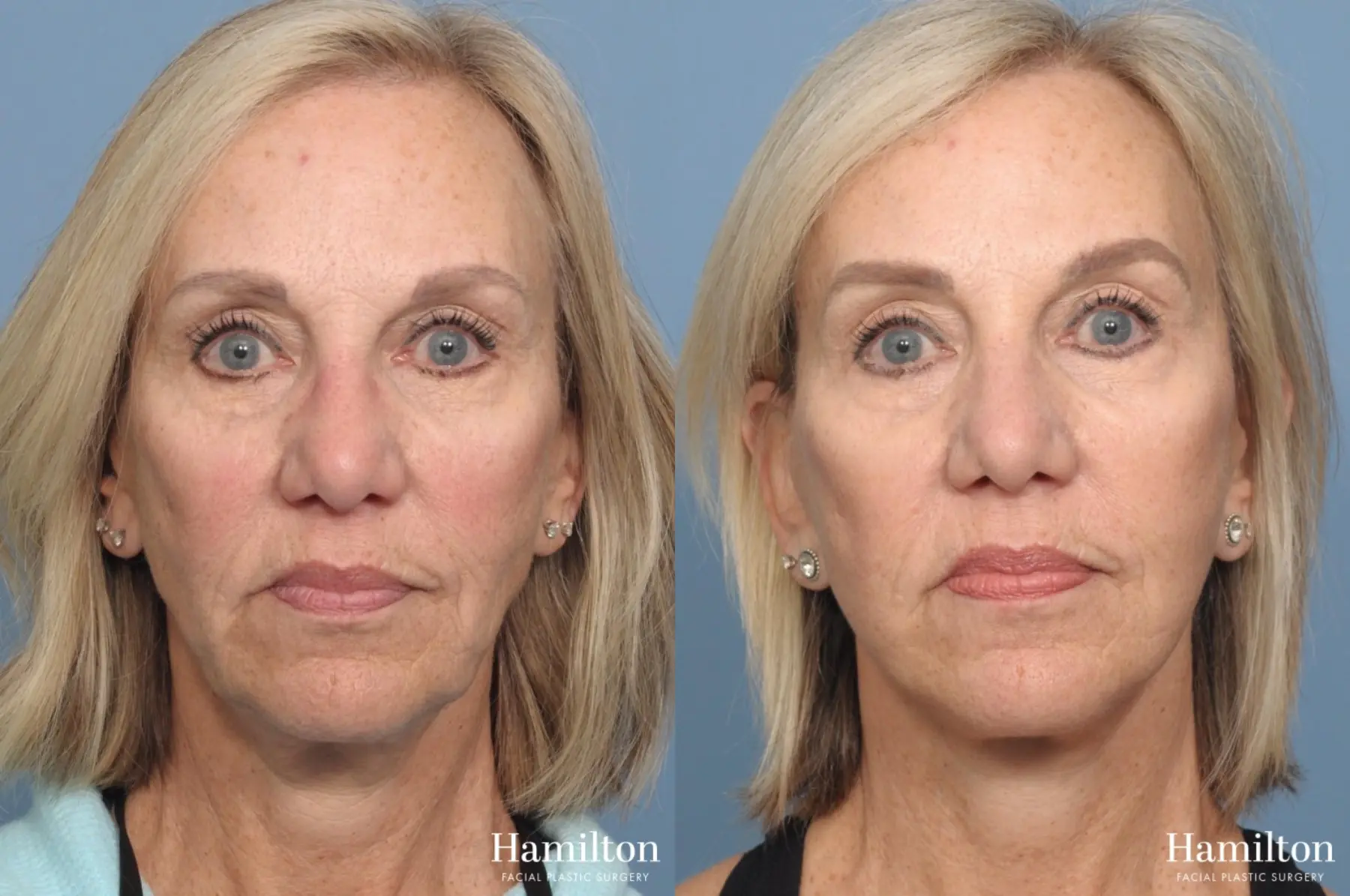Mini Facelift: Patient 1 - Before and After 3