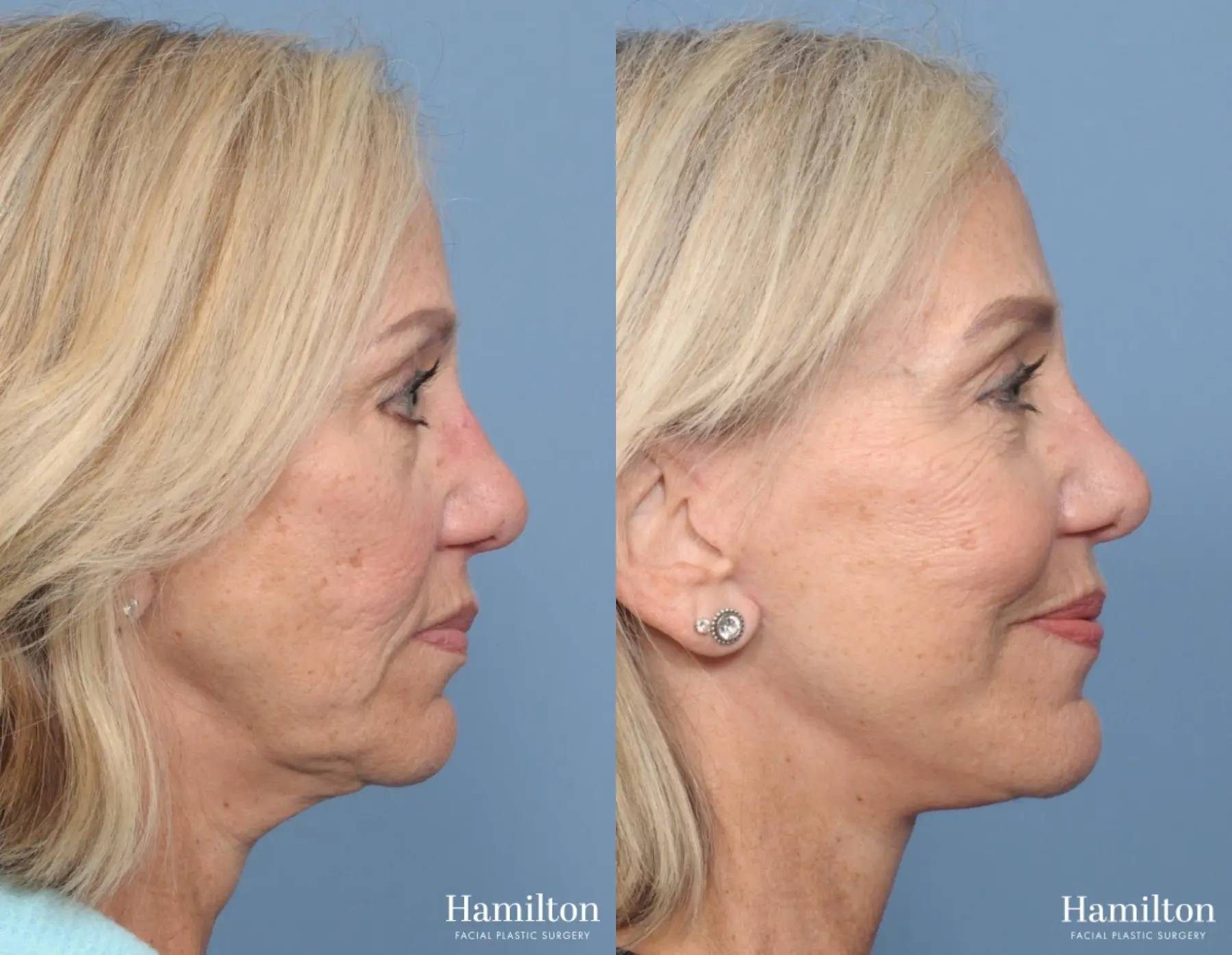 Mini Facelift: Patient 1 - Before and After 2