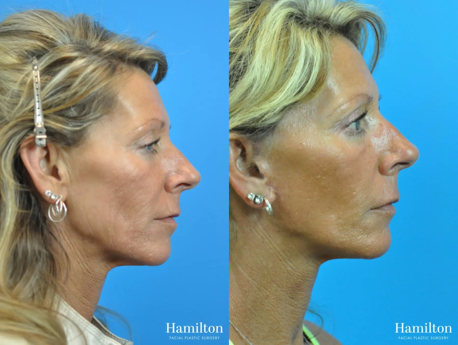 Mini Facelift: Patient 3 - Before and After 3