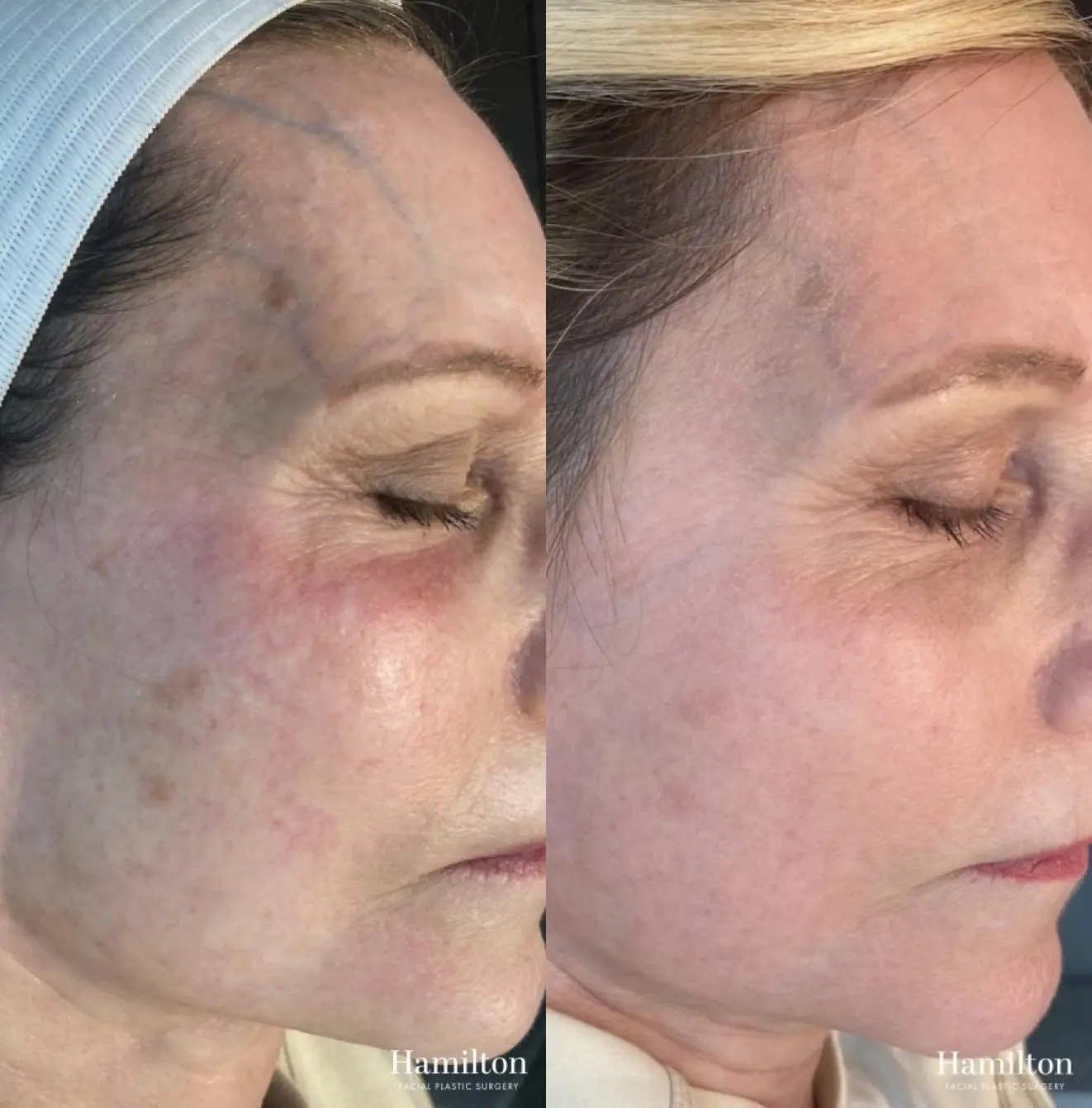 MOXI Laser: Patient 1 - Before and After  