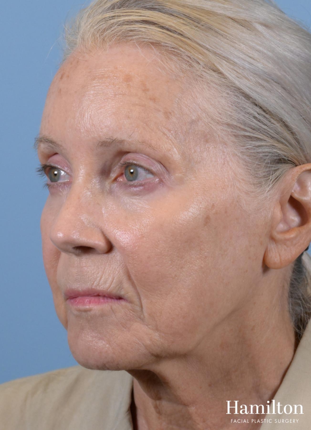 Facelift: Patient 3 - Before 4