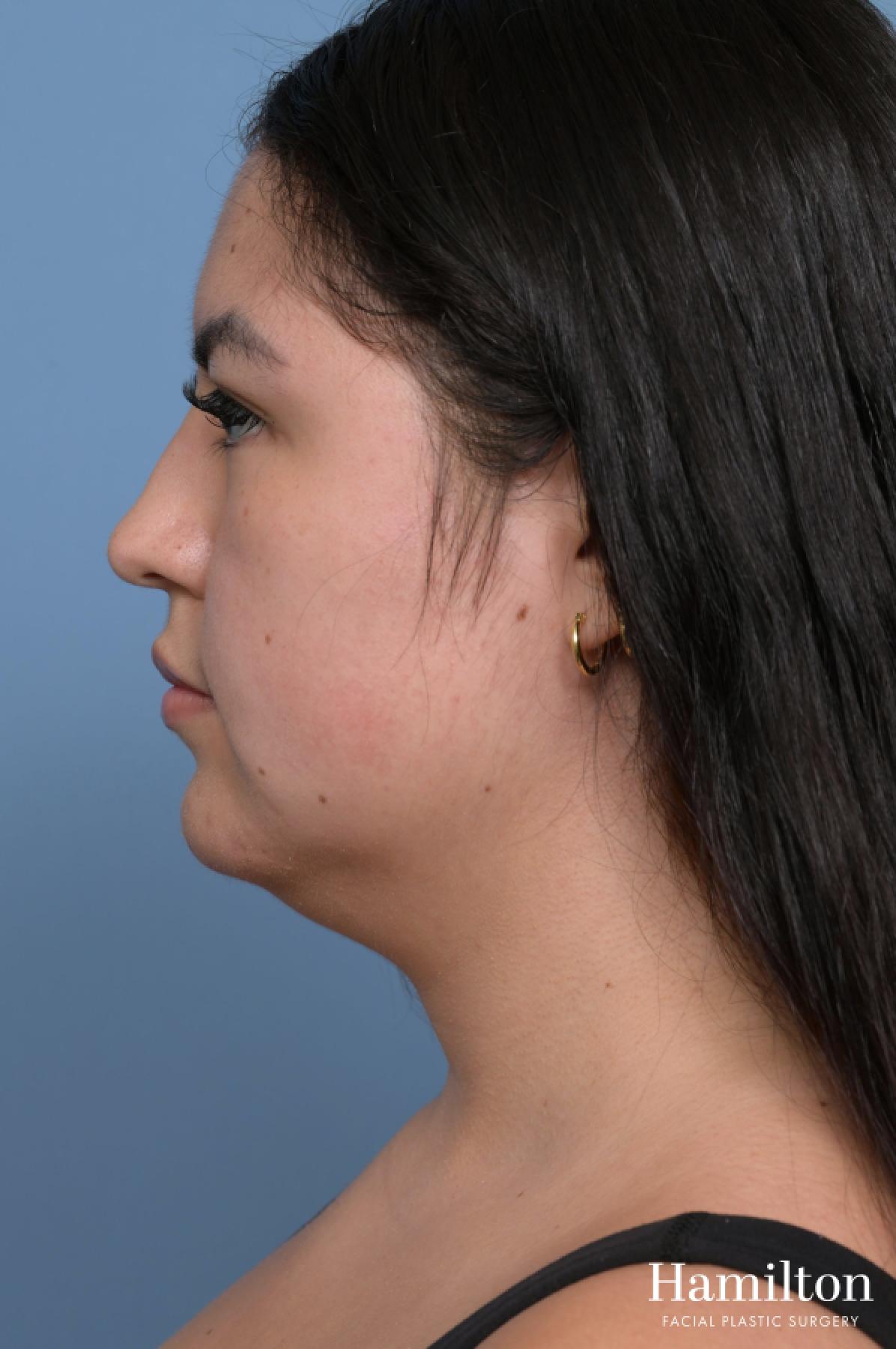 Buccal Fat Removal: Patient 1 - Before 4