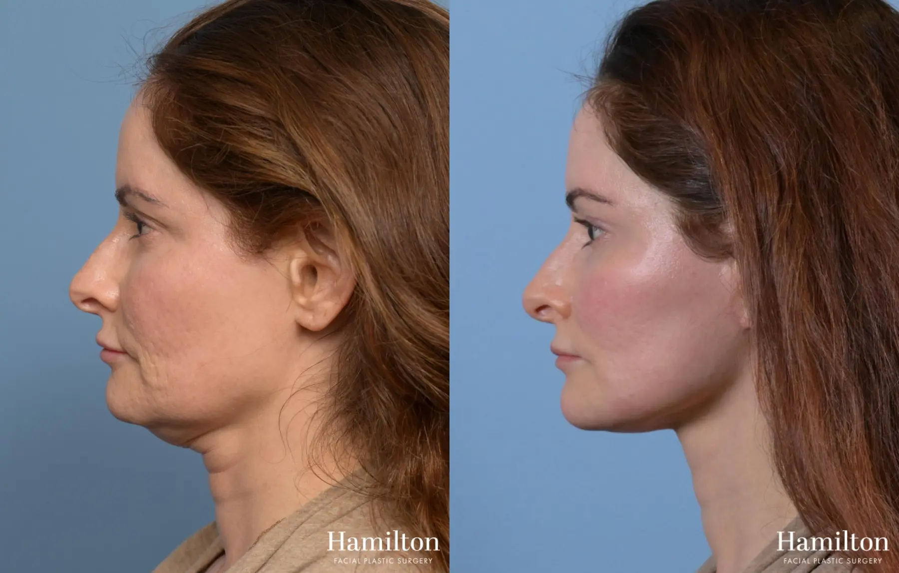 Neck Rejuvenation: Patient 1 - Before and After 3