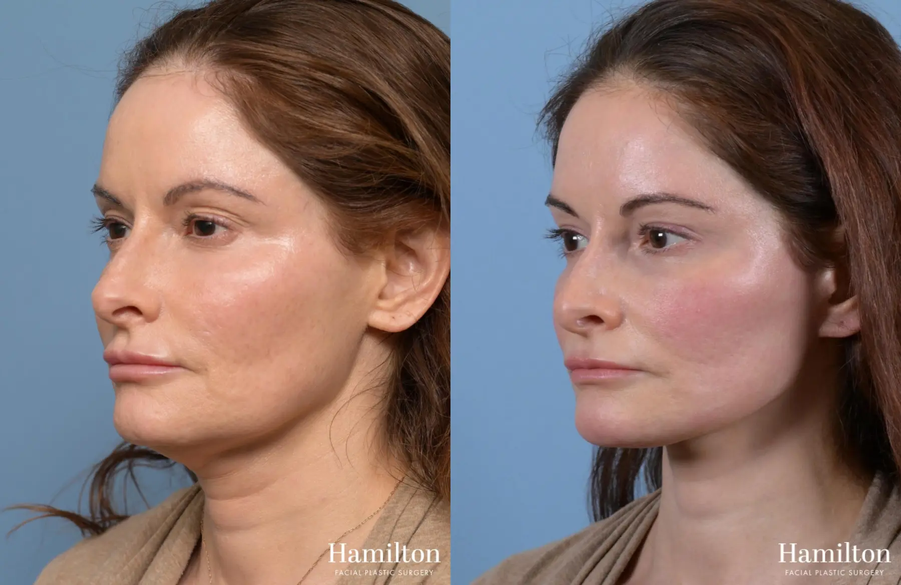 Neck Rejuvenation: Patient 1 - Before and After 4