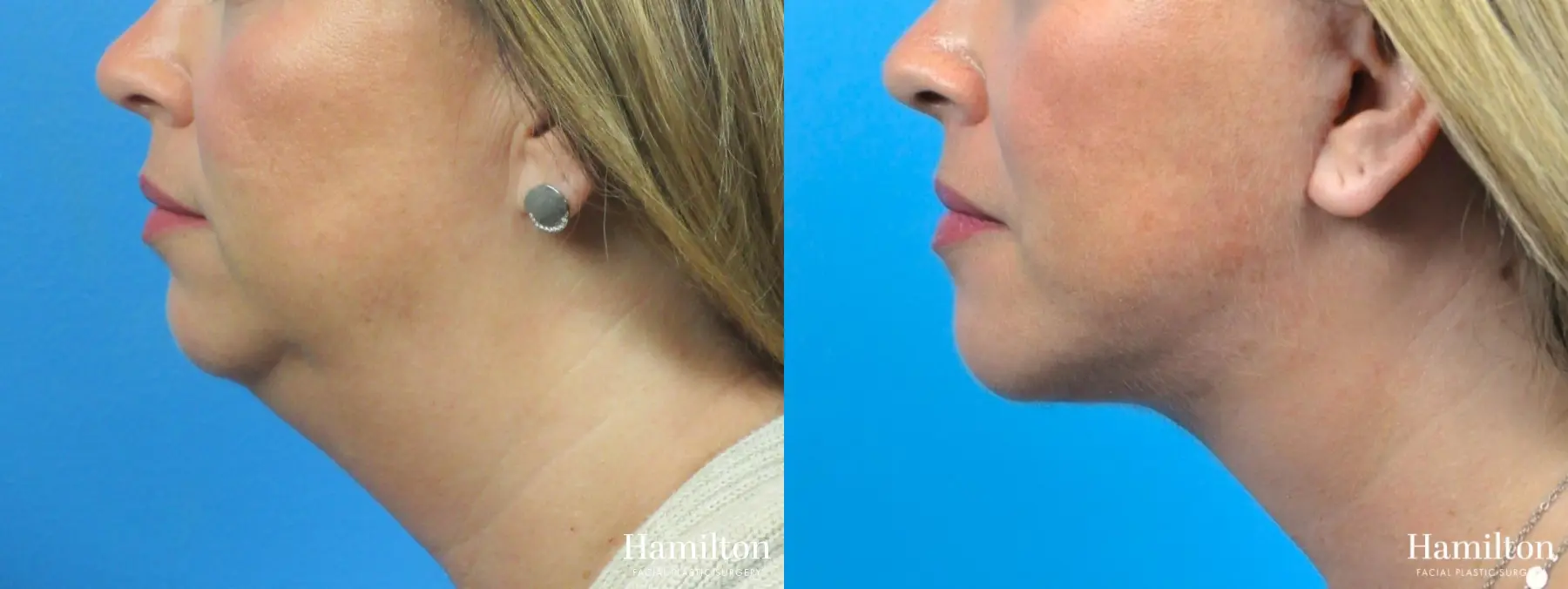 Neck Rejuvenation: Patient 6 - Before and After 1